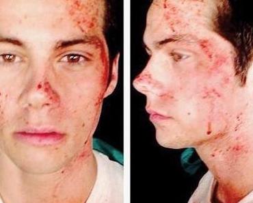 THE MAZE RUNNER : Dylan O’brien blessé sur le tournage